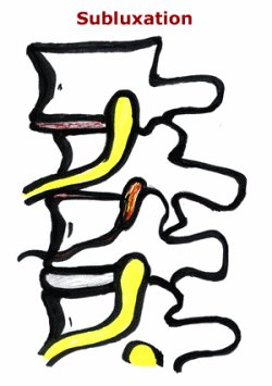 Picture of a subluxation